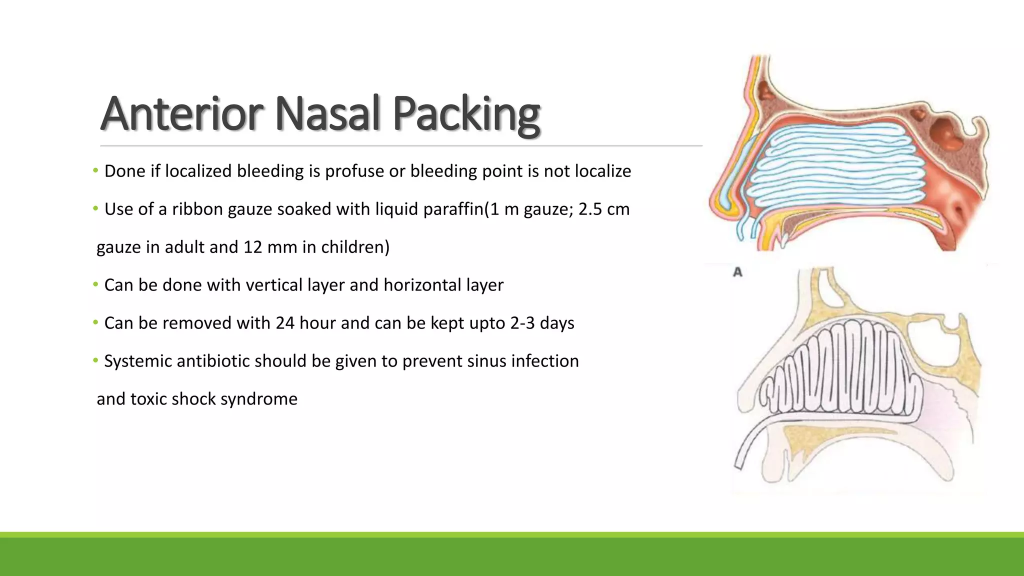 Anterior Nasal Packing
• Done if localized bleeding is profuse or bleeding point is not localize
• Use of a ribbon gauze soaked with liquid paraffin(1 m gauze; 2.5 cm
gauze in adult and 12 mm in children)
• Can be done with vertical layer and horizontal layer
• Can be removed with 24 hour and can be kept upto 2-3 days
• Systemic antibiotic should be given to prevent sinus infection
and toxic shock syndrome
 
