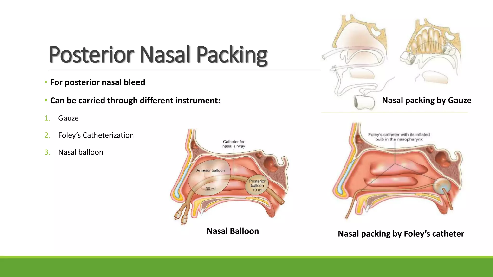 Posterior Nasal Packing
• For posterior nasal bleed
• Can be carried through different instrument:
1. Gauze
2. Foley’s Catheterization
3. Nasal balloon
Nasal packing by Gauze
Nasal packing by Foley’s catheterNasal Balloon
 
