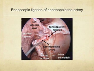 Endoscopic ligation of sphenopalatine artery
 