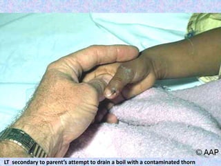 LT secondary to parent’s attempt to drain a boil with a contaminated thorn
 