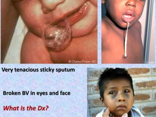 Very tenacious sticky sputum
Broken BV in eyes and face
What is the Dx?
 