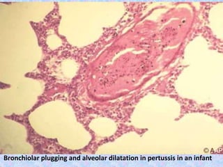 Bronchiolar plugging and alveolar dilatation in pertussis in an infant
 