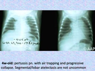 4w-old: pertussis pn. with air trapping and progressive
collapse. Segmental/lobar atelectasis are not uncommon
 