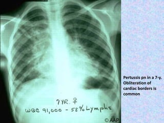Pertussis pn in a 7-y.
Obliteration of
cardiac borders is
common
 