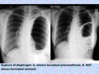 Rupture of diaphragm: A. mimics loculated pneumothorax. B. NGT
shows herniated stomach
 