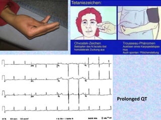Prolonged QT
 