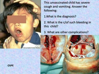 This unvaccinated child has severe
cough and vomiting. Answer the
following:
1.What is the diagnosis?
2. What is the c/of such bleeding in
this child?
3. What are other complications?
OSPE
 