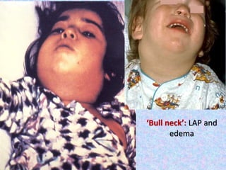 ‘Bull neck’: LAP and
edema
 