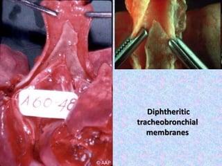 Diphtheritic
tracheobronchial
membranes
 