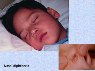 Nasal diphtheria
 