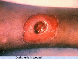 Diphtheria in wound
 
