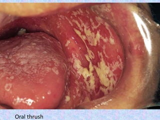 Oral thrush
 