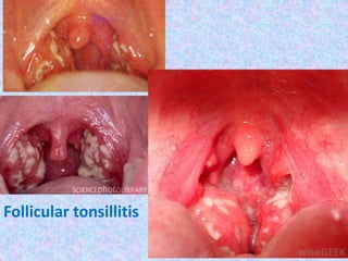 Follicular tonsillitis
 