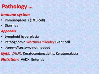 Pathology …
Immune system
• Immunoparesis (T&B cell)
• Diarrhea
Appendix
• Lymphoid hyperplasia
• Pathognomic Warthin-Finkeldey Giant cell
• Appendicectomy not needed
Eyes: VADX, Keratoconjunctivitis, Keratomalacia
Nutrition: VADX, Enteritis
 
