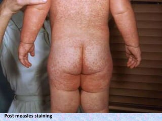 Post measles staining
 