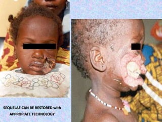 SEQUELAE CAN BE RESTORED with
APPROPIATE TECHNOLOGY
 