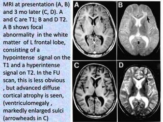 MRI at presentation (A, B)
and 3 mo later (C, D). A
and C are T1; B and D T2.
A B shows focal
abnormality in the white
matter of L frontal lobe,
consisting of a
hypointense signal on the
T1 and a hyperintense
signal on T2. In the FU
scan, this is less obvious
, but advanced diffuse
cortical atrophy is seen,
(ventriculomegaly ,
markedly enlarged sulci
(arrowheads in C)
 