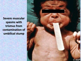 Severe muscular
spasms with
trismus from
contamination of
umbilical stump
 