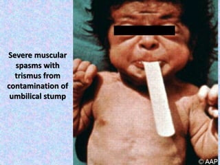 Severe muscular
spasms with
trismus from
contamination of
umbilical stump
 