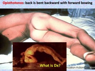 Opisthotonos: back is bent backward with forward bowing
What is Dx?
 