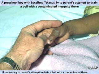 LT secondary to parent’s attempt to drain a boil with a contaminated thorn
A preschool boy with Localized Tetanus 2y to parent’s attempt to drain
a boil with a contaminated mesquite thorn
 