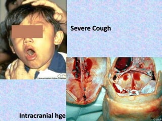 Intracranial hge
Severe Cough
 