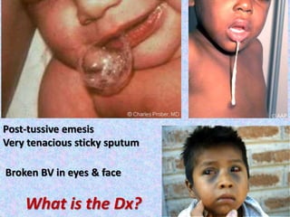 Post-tussive emesis
Very tenacious sticky sputum
Broken BV in eyes & face
What is the Dx?
 