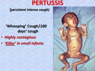 ‘Whooping’ Cough/100
days’ cough
• Highly contagious
• ‘Killer’ in small infants
PERTUSSIS
(persistent intense cough)
 