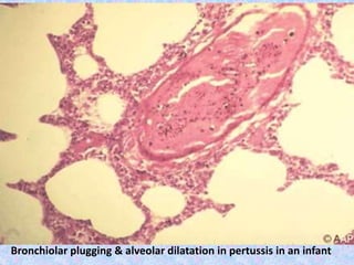 Bronchiolar plugging & alveolar dilatation in pertussis in an infant
 