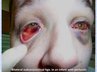 Bilateral subconjunctival hge. in an infant with pertussis
 