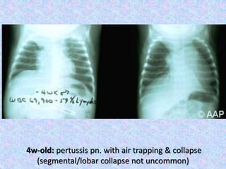 4w-old: pertussis pn. with air trapping & collapse
(segmental/lobar collapse not uncommon)
 