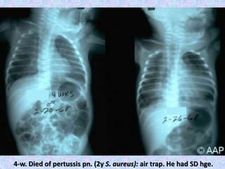 4-w. Died of pertussis pn. (2y S. aureus): air trap. He had SD hge.
 