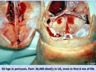 SD hge in pertussis. Past: 36,000 died/y in US, most in first 6 mo of life
 