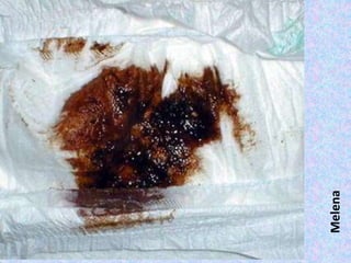 Melena
 