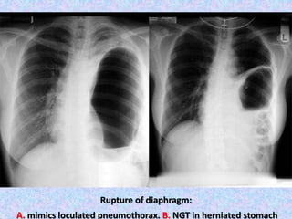 Rupture of diaphragm:
A. mimics loculated pneumothorax. B. NGT in herniated stomach
 