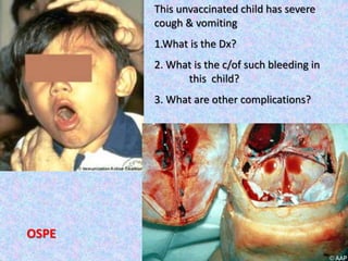 This unvaccinated child has severe
cough & vomiting
1.What is the Dx?
2. What is the c/of such bleeding in
this child?
3. What are other complications?
OSPE
 