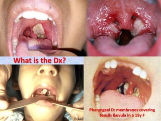 What is the Dx?
Pharyngeal D: membranes covering
tonsils &uvula in a 15y F
 