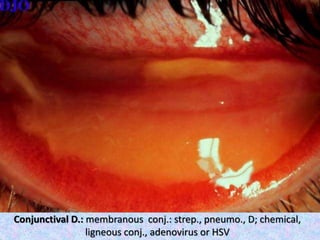 Conjunctival D.: membranous conj.: strep., pneumo., D; chemical,
ligneous conj., adenovirus or HSV
 