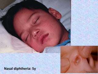 Nasal diphtheria: 5y
 