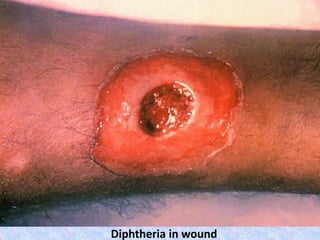 Diphtheria in wound
 