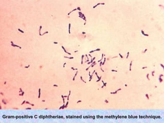 Gram-positive C diphtheriae, stained using the methylene blue technique.
 
