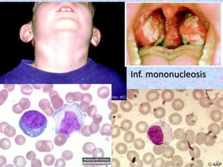 Inf. mononucleosis
 