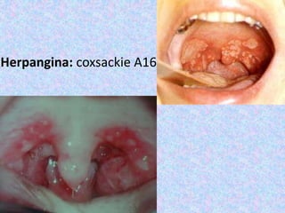 Herpangina: coxsackie A16
 