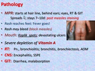 Pathology
• MPR: starts at hair line, behind ears; eyes, RT & GIT
Spreads ; stays 7–10d: post measles staining
• Rash reaches feet: Fever goes!
• Rash may bleed (black measles)
• Mouth: Koplik spots; devastating ulcers
• Severe depletion of Vitamin A
• RT: Pn., bronchiolitis; bronchitis, bronchiectasis, AOM
• CNS: Encephalitis, SSPE
• GIT: Diarrhea, malabsorption
 