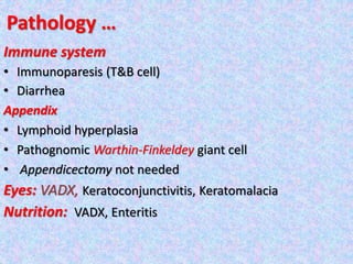 Pathology …
Immune system
• Immunoparesis (T&B cell)
• Diarrhea
Appendix
• Lymphoid hyperplasia
• Pathognomic Warthin-Finkeldey giant cell
• Appendicectomy not needed
Eyes: VADX, Keratoconjunctivitis, Keratomalacia
Nutrition: VADX, Enteritis
 