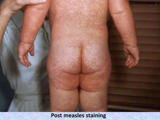 Post measles staining
 