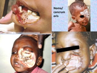 Noma/
cancrum
oris
 
