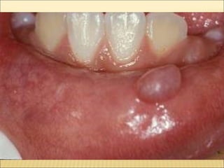 Epitelial cubierta y revestimiento