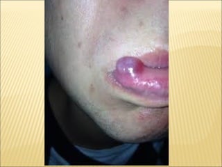 Epitelial cubierta y revestimiento