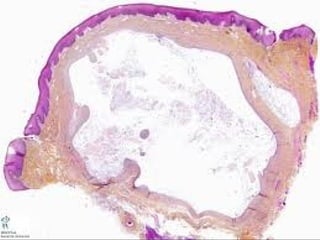 Epitelial cubierta y revestimiento